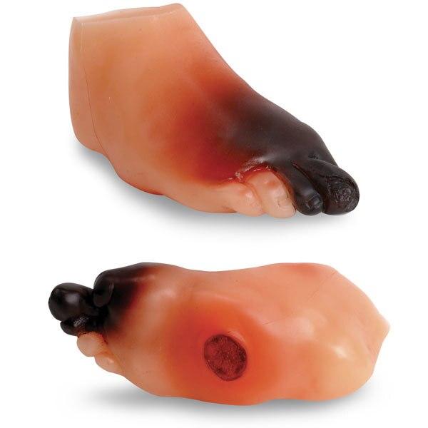 Severe Diabetic Foot Model | Nasco | Available from LivCor Australia