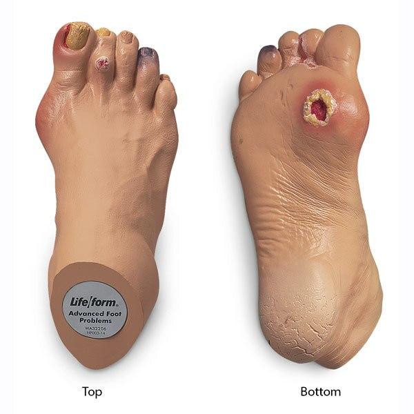 Advanced Foot Problems | Nasco | Available from LivCor Australia
