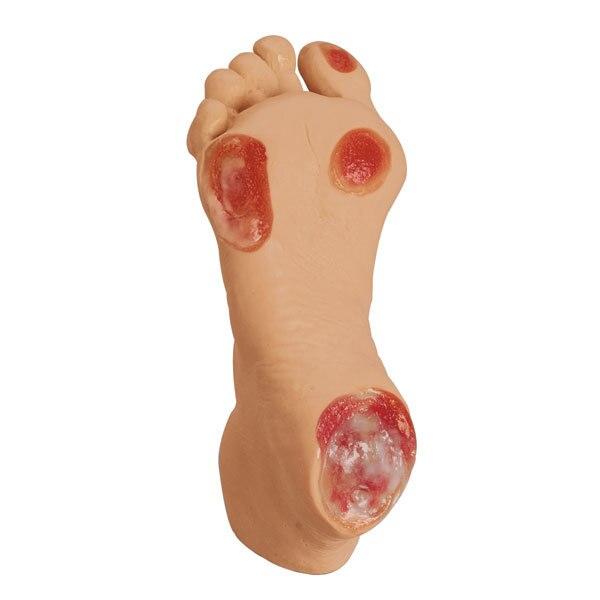 Elderly Pressure Ulcer Foot | Nasco | Available from LivCor Australia
