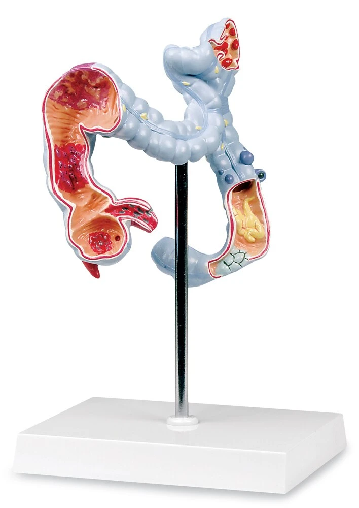 Colon Diseases Model for Medical Training | LivCor
