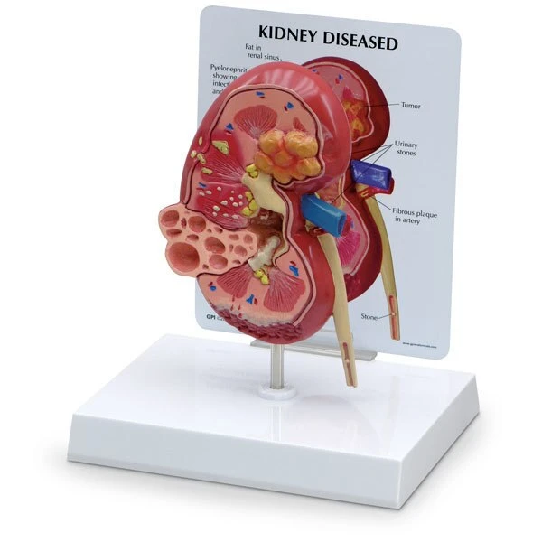 Kidney Model w/Pathologies | Nasco | Available from LivCor Australia