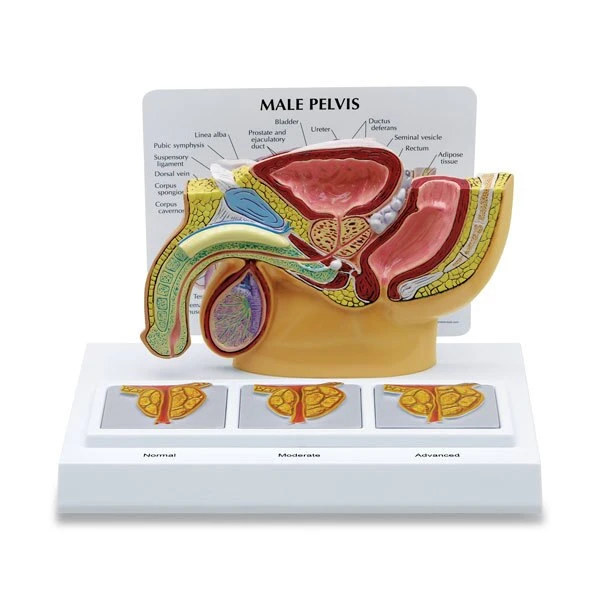 Male Pelvis with Prostate and BPH Model | Nasco | Available from LivCor Australia